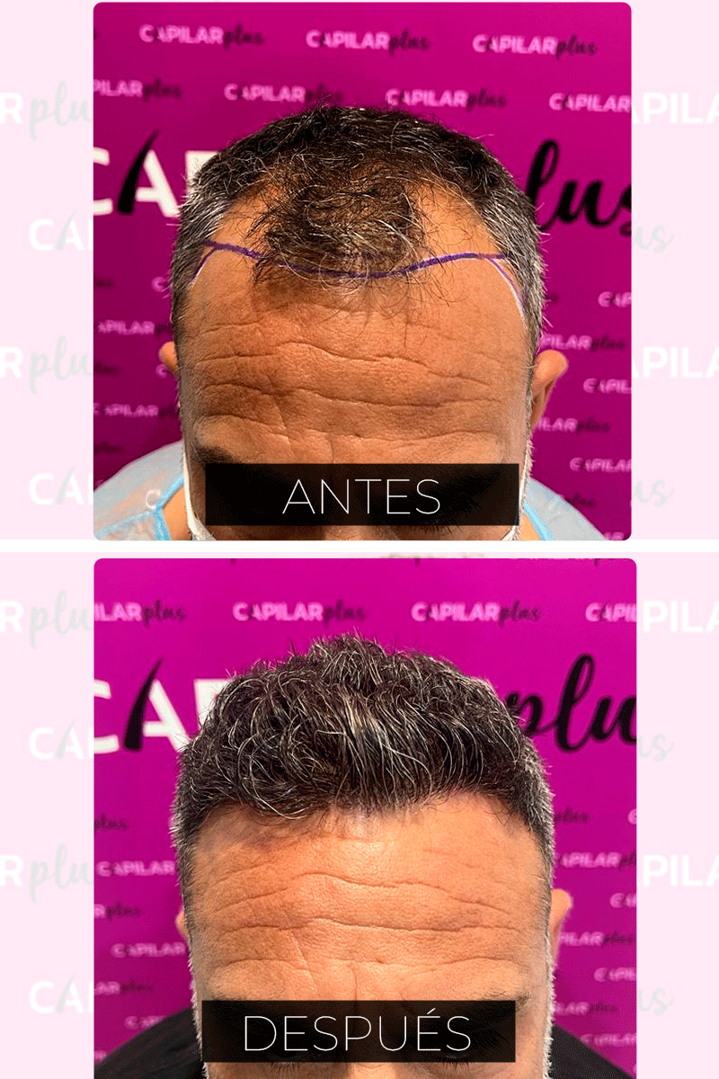 CAPILAR PLUS INJERTO SEVILLA