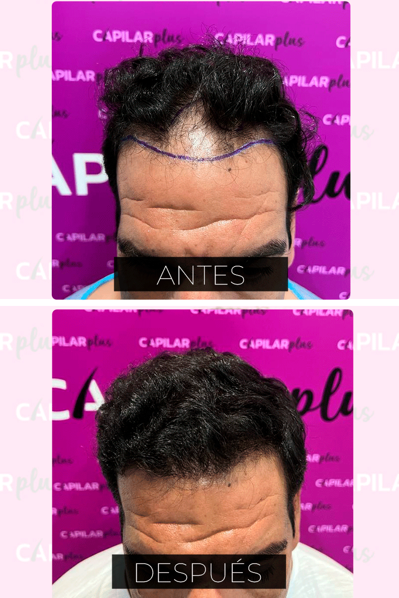 CLINICA CAPILAR SEVILLA