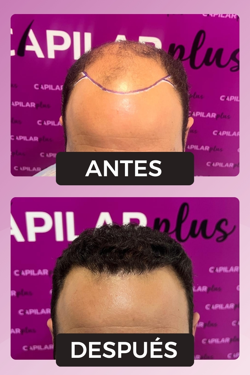 CLINICA CAPILAR SEVILLA