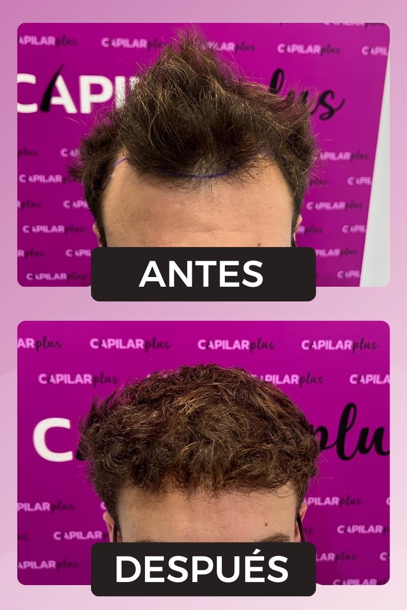 CLINICA CAPILAR SEVILLA