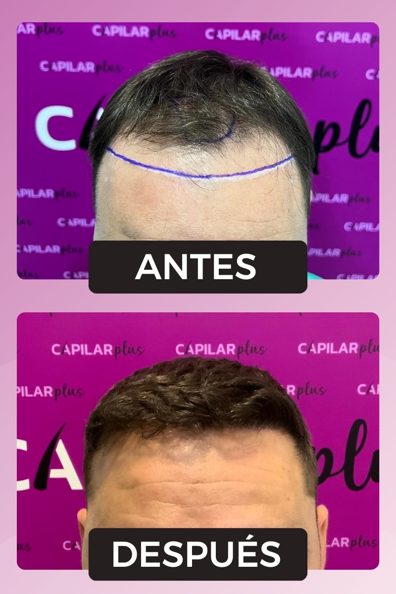 CAPILAR PLUS INJERTO SEVILLA