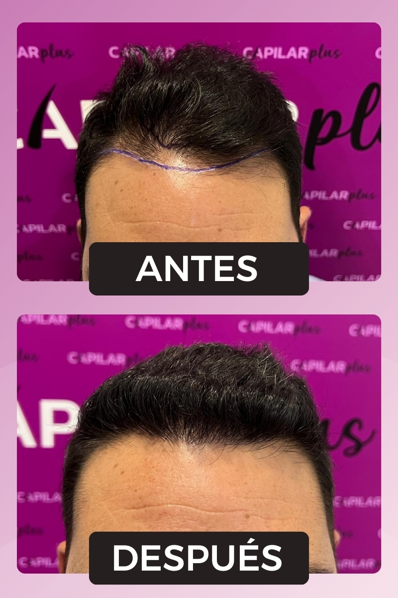 CAPILAR PLUS INJERTO SEVILLA