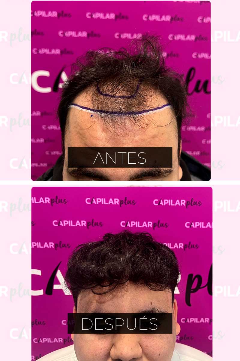 INJERTO CAPILAR SEVILLA